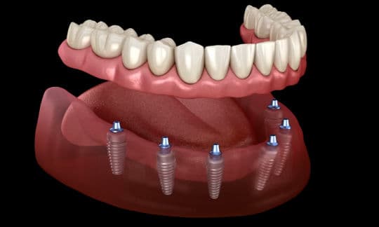 All-on-6 - Kalmar Implant Dentistry