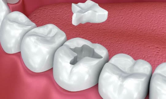 Keramik- und Kompositfüllungen - Kalmar Implant Dentistry