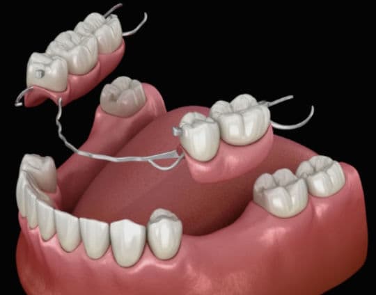 Proteza na sponkah - Kalmar Implant Dentistry