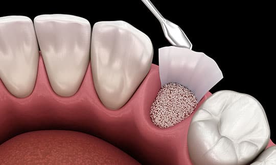 Aumento osseo - Kalmar Implant Dentistry